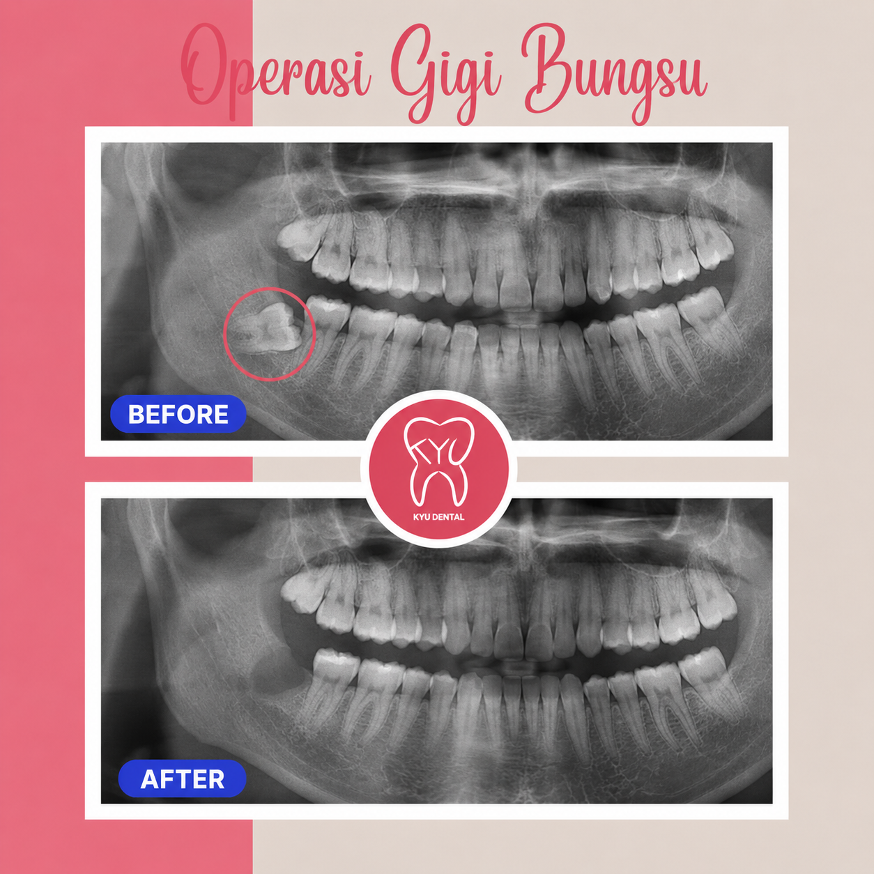 operasi gigi bungsu